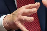 Biely dom vysvetluje naplasti na ruke Trumpa